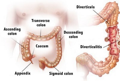 digestive disease diverticulitis