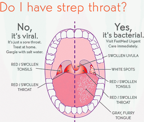 strep sthroat symptoms