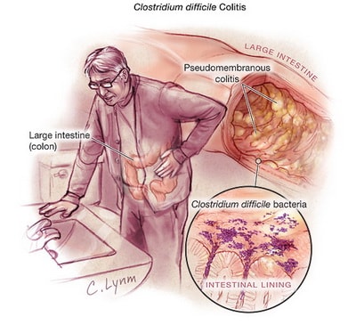 c diff symptoms