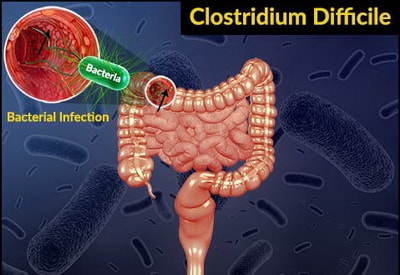 Clostridium difficile-fertőzés tünetei és kezelése - HáziPatika