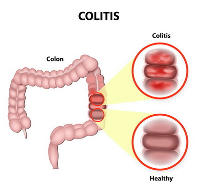colitis causes